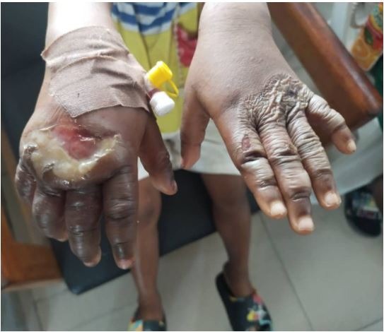 Mother puts five-year-old daughter’s hands in hot water for stealing fish in Cross River