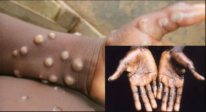 Lagos, Adamawa lead as NCDC confirms 15 monkeypox cases