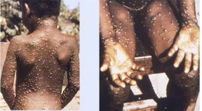 Monkeypox patient travels from Nigeria, says UK