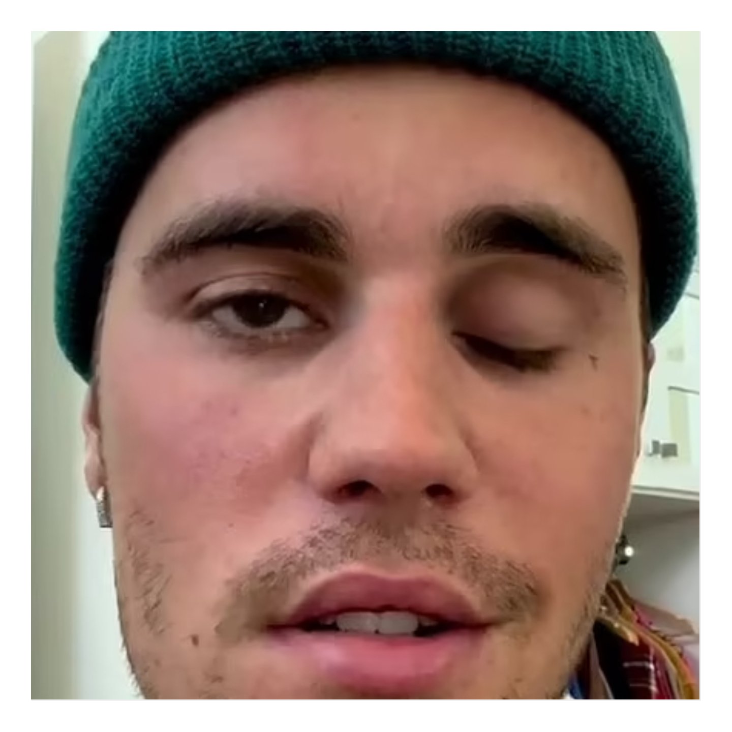 Justin Bieber ​suffers facial paralysis