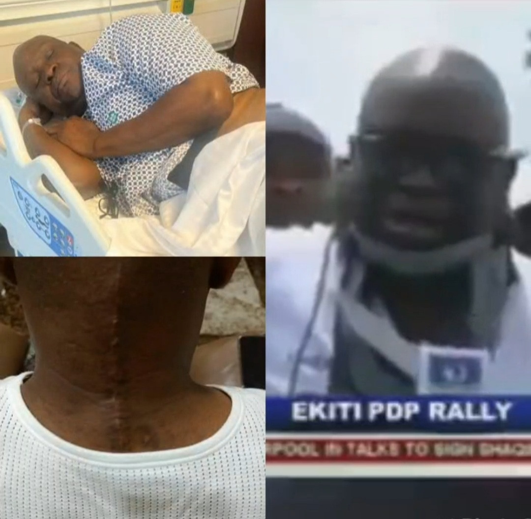 Former Ekiti state governor, Ayo Fayose, undergoes surgery