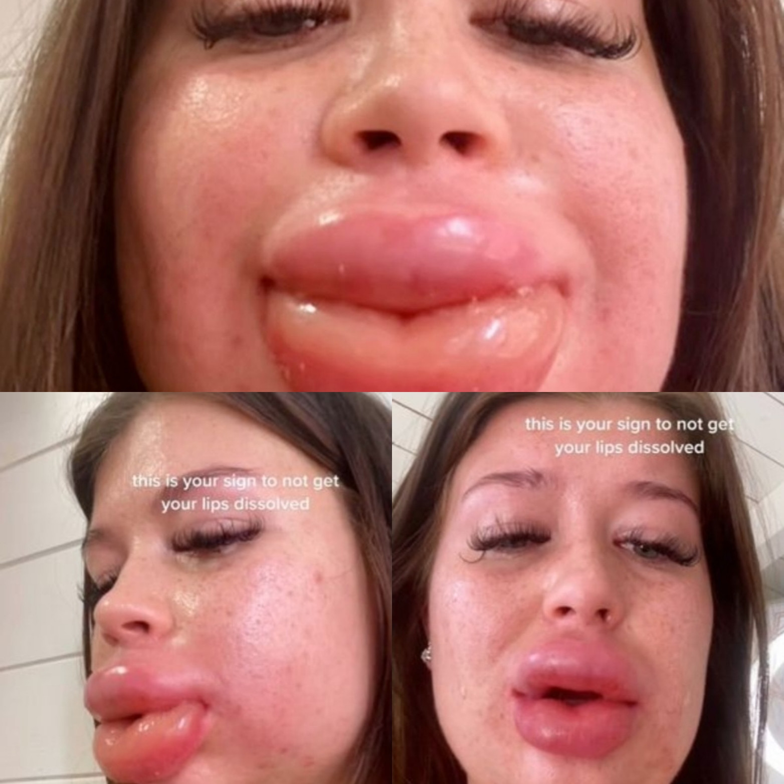 Woman warns as severe reaction to filler dissolvent causes Swollen Lips